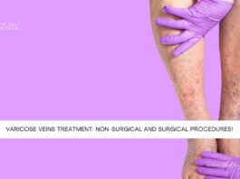 Varicose Veins Treatment Non-Surgical and Surgical Procedures- The Easy Wisdom- www.TheEasyWisdom.com